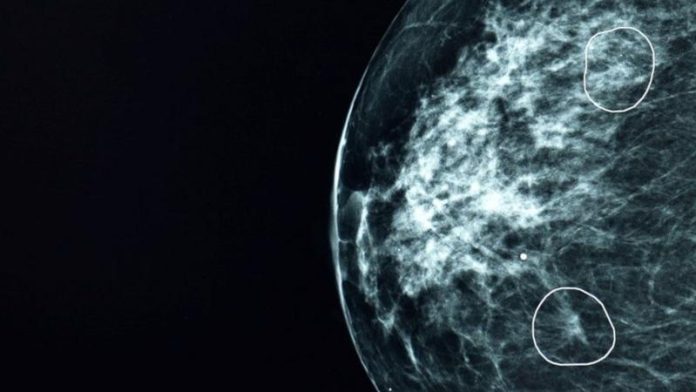 Examen de la herramienta para detectar el cáncer. Créditos: BBC Mundo